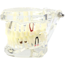 Verk 01964 Fogászati implantátum modell, fehér kreatív és készségfejlesztő